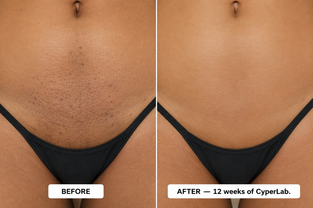 CyperLab — A Few Drops of This "Miracle Botanical" Replaces Laser, Waxing, and Daily Shaving