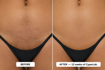 CyperLab — A Few Drops of This "Miracle Botanical" Replaces Laser, Waxing, and Daily Shaving